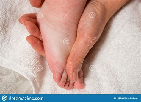 Legs Of Little Child With Red Rash Closeup Concept Of Babies