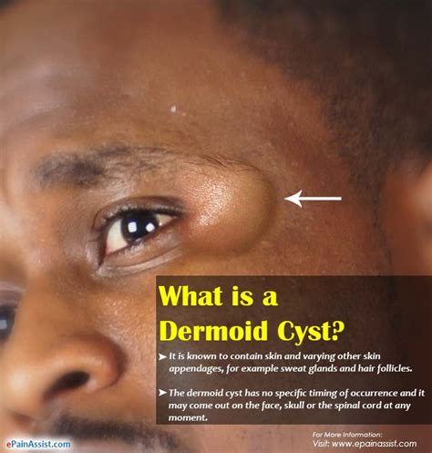 What Causes A Dermoid Cystsymptoms Treatment Of Ovarian Dermoid Cyst
