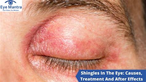 Shingles In The Eye Symptoms Causes Treatment And Prevention Porn Sex Picture