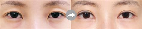 Best Double Eyelid Surgery Double Eyelid Treatment In Korea The Line