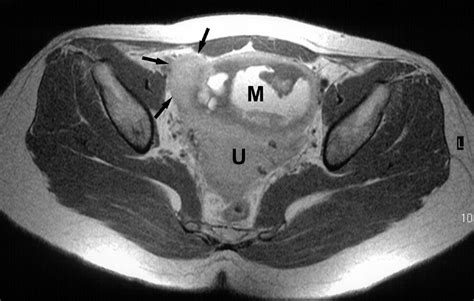 Atypical CT And MRI Manifestations Of Mature Ovarian Cystic Teratomas AJR