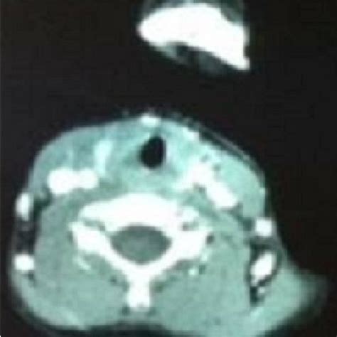 Ct Scan Sagittal View That Shows A Retropharyngeal Abscess With