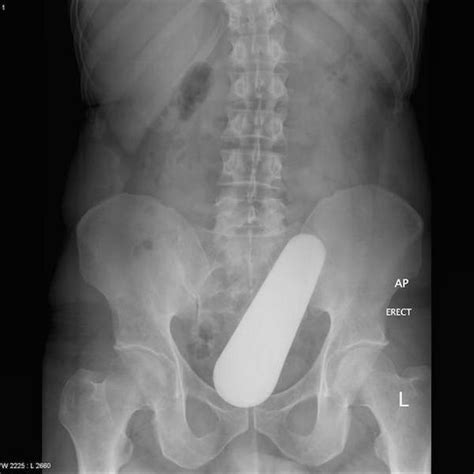 Website Compiles X Ray Photos Of Weird Things Stuck Up Peoples Butts