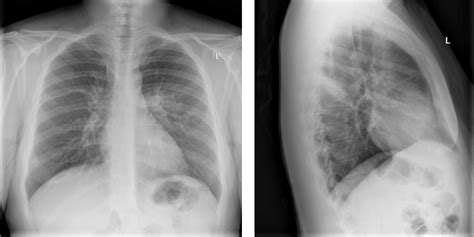 Interpreting Chest X Rays — Taming The Sru