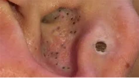 Most Satisfying Pimple Popping And Blackheads 3 How