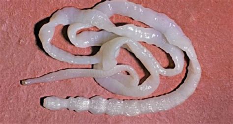 Man Dies After ‘catching Cancer From His Tapeworm