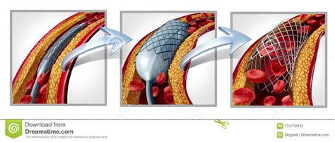 Stent Cartoons Illustrations And Vector Stock Images 393 Pictures To