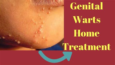 Genital Warts Home Treatment Youtube
