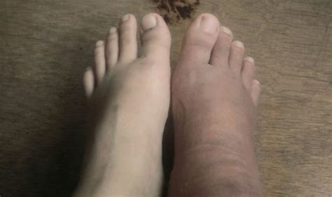 Swollen Feet And Ankles Could Be A Symptom Of These Health Conditions