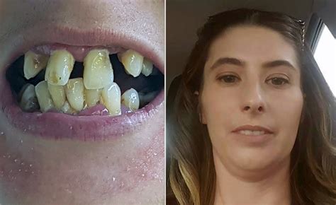 Mum Got £17k Worth Of New Teeth For Free Thanks To Alpers Dental Company Metro News