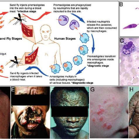 Leishmania Life Cycle And Clinical Syndromes A Diagrammatic Download Scientific Diagram