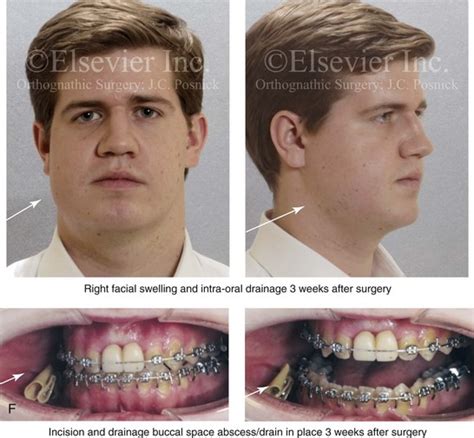 16 Complications Associated With Orthognathic Surgery Pocket Dentistry