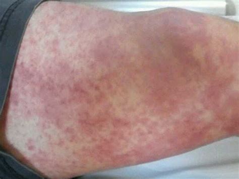 Image Of The Week Macular Rash On Both Legs Clinical Advisor