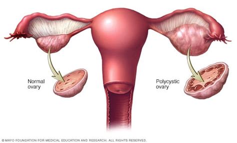 Polycystic Ovary Syndrome Symptoms Causes And Complications