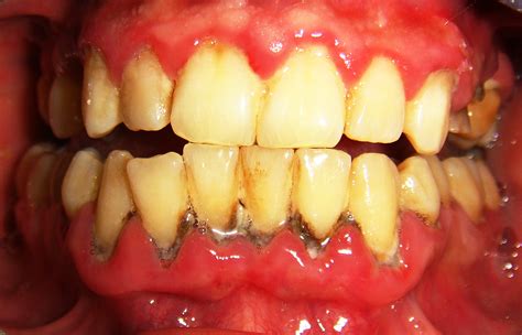 Symptoms Of Gum Disease Clevertopic