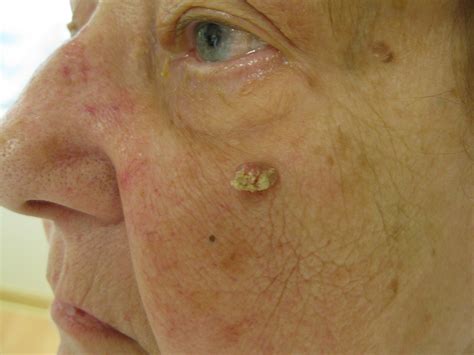 Squamous Cell Carcinoma Of The Skin The Clinical Advisor
