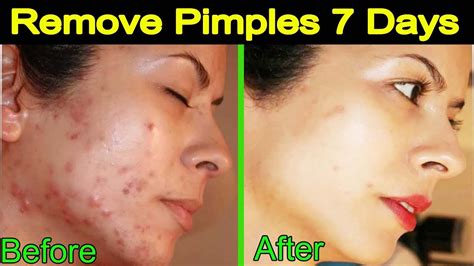 How To Remove Pimples And Dark Spots In Just 7 Days 100 Natural