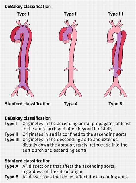 The Diagnosis And Management Of Aortic Dissection The Bmj