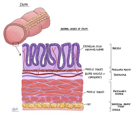 Adenocarcinoma Of The Colon And Rectum Mypathologyreportca 2022