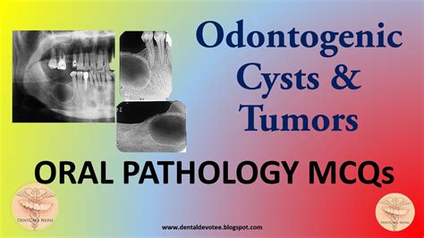 Oral Pathology Mcqs Cysts And Tumors Of The Jaws And Oral Cavity