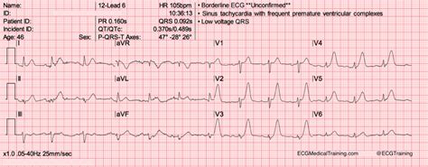 Descriptionde winter's t wave (ecg).svg. De Winter ST/T-Waves - ECG Medical Training