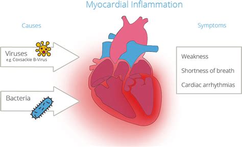 Heart Muscle Inflammation Myocarditis Cardiosecur