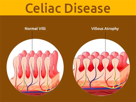 Celiac Disease Symptoms Causes Risk Factors Diagnosis And Treatment