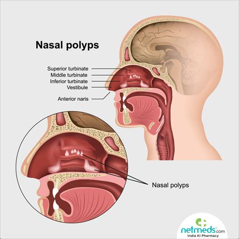 Nasal Polyps Causes Symptoms And Treatment Netmeds