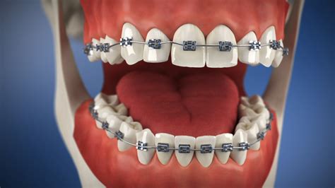 Braces Broken Down Terms Smile Creations Dr Steinberg