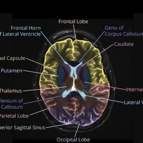 Mri Sectional Anatomy Of Brain Brain Anatomy Mri Frontal Lobe Images And Photos Finder