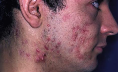 Topical Minocycline Foam Safe Effective For Moderate To Severe Acne