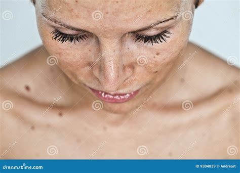 Woman Leg With Red Sunburn Skin On Seaside Background Sunburned Skin