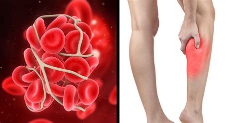 If You Notice These Symptoms You May Have A Serious Blood Clot
