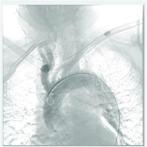 Type Iii Aortic Arch Angiogram Shows That The Patient Has Type Iii