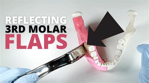 How To Reflect And Retract A Full Thickness Flap For Third Molar