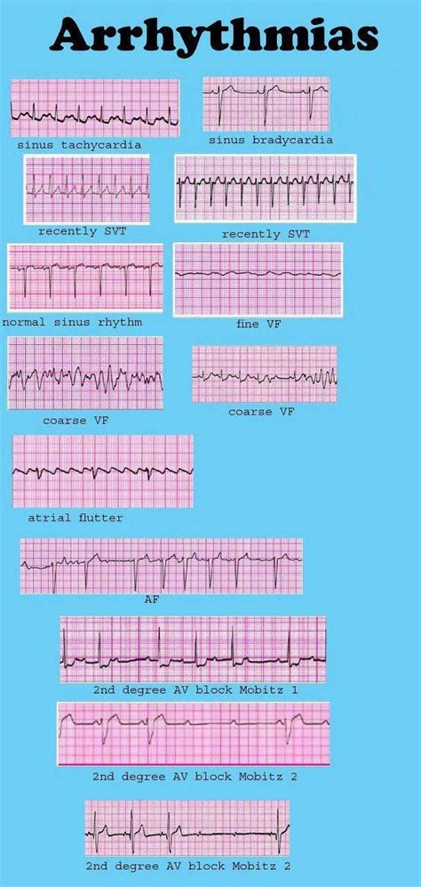 Dysrhythmia Cheat Sheet Arrhythmia Recognition Acls Pinterest Images And Photos Finder