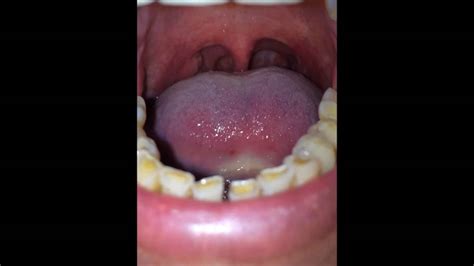 Man Uvula 2 Youtube