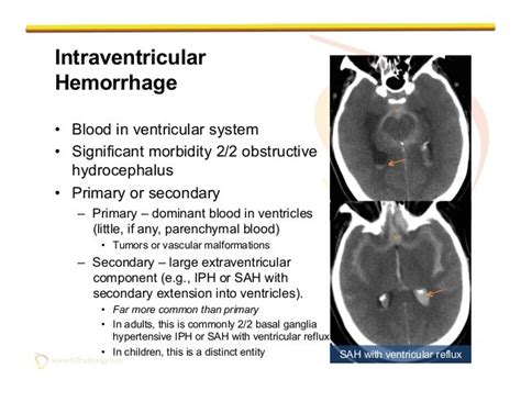 Imaging Of Non Traumatic Intracranial Hemorrhage