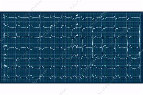 Current trends in diagnosis and treatment. Myocarditis, ECG - Stock Image - C036/5381 - Science Photo Library