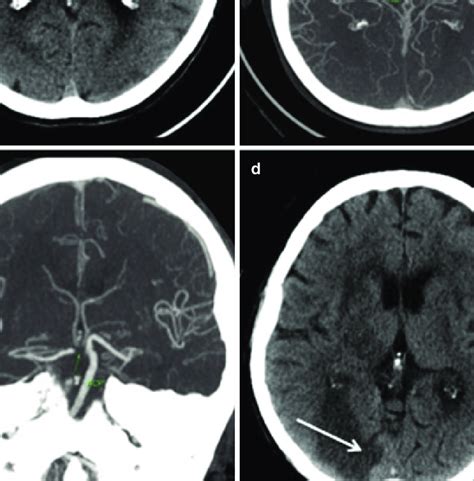 Communicans.in stroke of the middle cerebral artery, the basal nuclei, internal capsule and lateral nuclei of the thalamus are most often affected (with signs of its dysfunction). 2 Ischemic stroke of the right posterior cerebral artery ...
