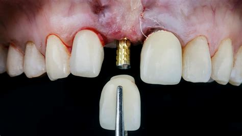 Signs You Need To Replace Your Dental Crown By Schellenberg Dental Medium