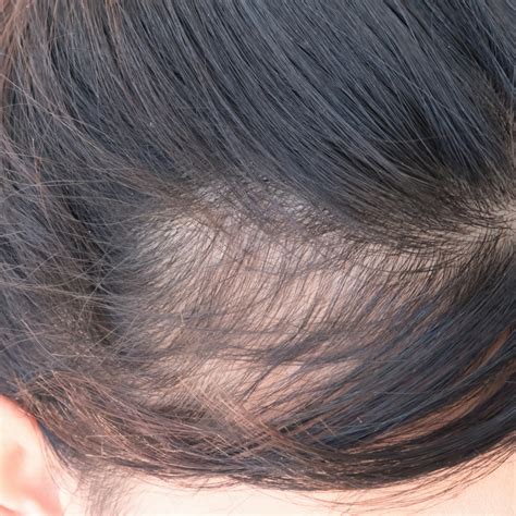 Can vitamins cause hair loss? Vitamin deficiencies can cause hair loss. A deficiency in ...