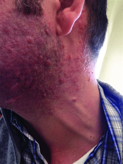 A B Clinical Appearance Multiple Firm Pink Brown Papules Or Nodules