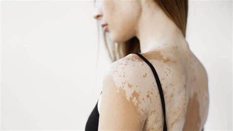 Plaques Blanches Dépigmentation Des Poils Comment Soigner Le Vitiligo