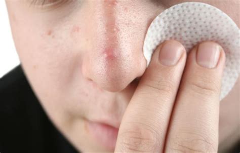 Blackhead Removal Things To Consider