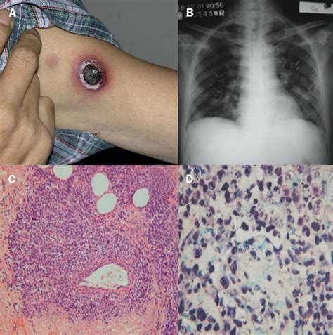 A Cutaneous Sore With Black Eschar In A Cowhide Worker The Lancet