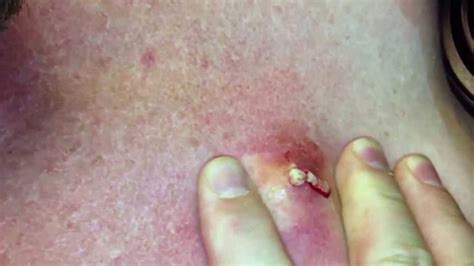 Sebaceous Cyst Type Causes Diagnosis And Treatment