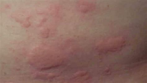 Skin Rashes Latest News On Skin Rashes Breaking Stories And Opinion