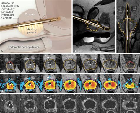 Magnetic Resonance Imaging Guided Transurethral Ultrasound Ablation Of Prostate Cancer Journal