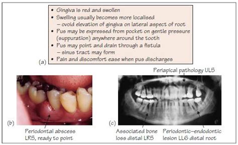 39 Periodontal Abscess And Periodonticendodontic Lesions Pocket